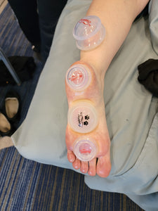 SYRACUSE, NY - July 8-9 - Evidence Informed Clinical Cupping